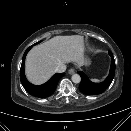 File:Acute renal artery occlusion (Radiopaedia 86586-102682 Axial C+ portal venous phase 4).jpg