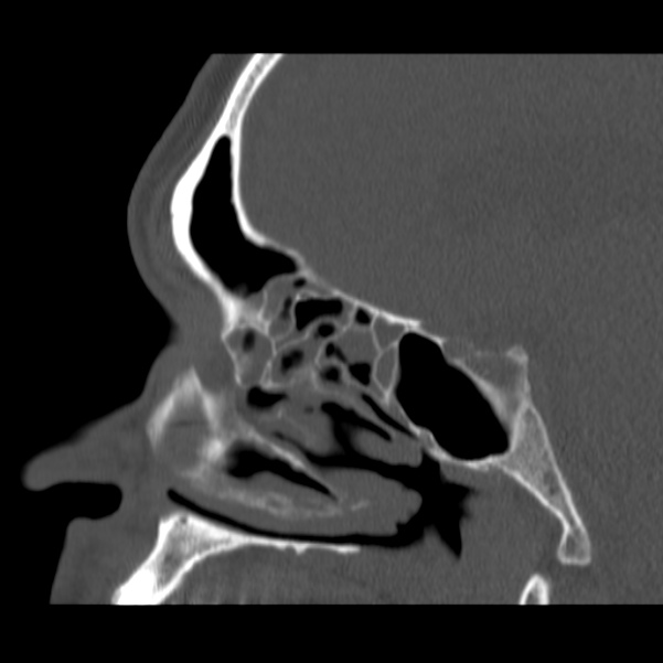 Acute sinusitis (Radiopaedia 23161-23215 Sagittal bone window 38).jpg