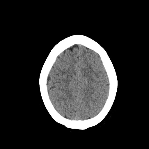 Acute subarachnoid hemorrhage and accessory anterior cerebral artery (Radiopaedia 69231-79008 Axial non-contrast 43).jpg