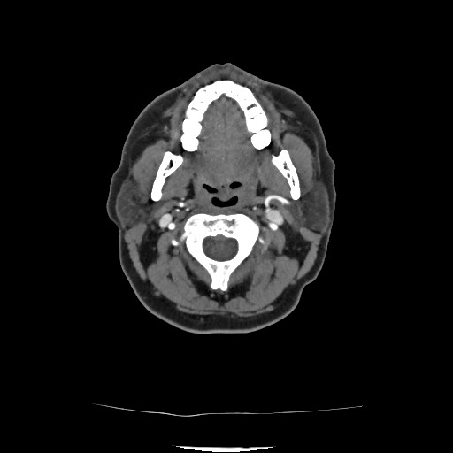 File:Acute subarachnoid hemorrhage and accessory anterior cerebral artery (Radiopaedia 69231-79009 Axial C+ arterial phase 64).jpg