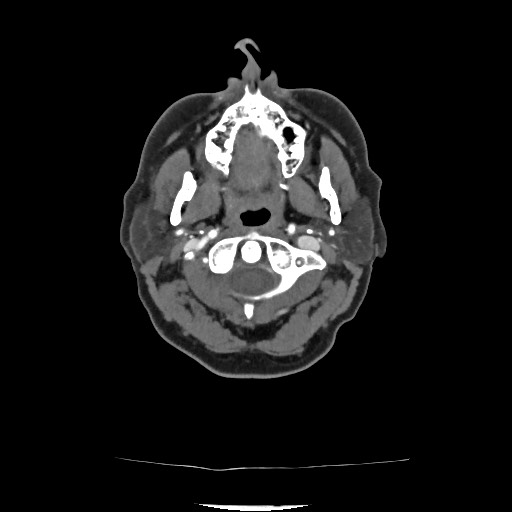 Acute subarachnoid hemorrhage and accessory anterior cerebral artery (Radiopaedia 69231-79009 Axial C+ arterial phase 68).jpg