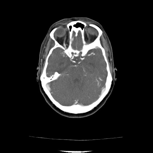 Acute subarachnoid hemorrhage and accessory anterior cerebral artery (Radiopaedia 69231-79009 Axial C+ arterial phase 89).jpg