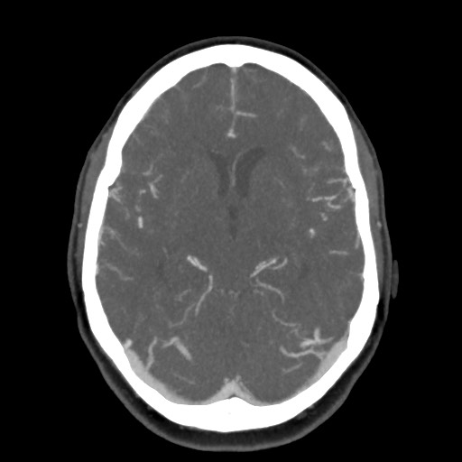 Acute subarachnoid hemorrhage and accessory anterior cerebral artery (Radiopaedia 69231-79009 D 32).jpg