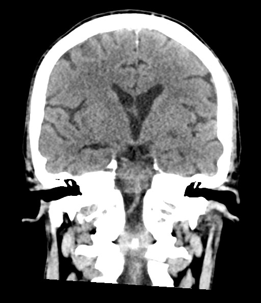 File:Acute superior cerebellar artery territory infarct (Radiopaedia 84104-99359 Coronal non-contrast 50).jpg