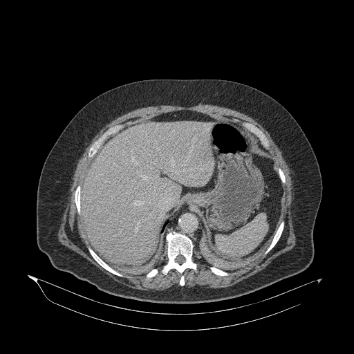 Acute superior mesenteric artery occlusion (Radiopaedia 51288-56960 Axial C+ portal venous phase 17).jpg