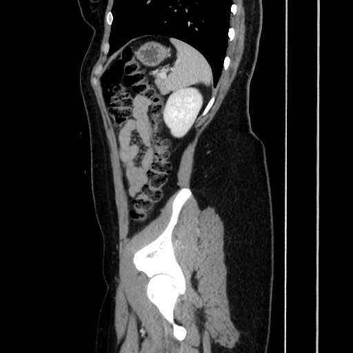 Acute uncomplicated appendicitis (Radiopaedia 73704-84499 Sagittal C+ portal venous phase 154).jpg