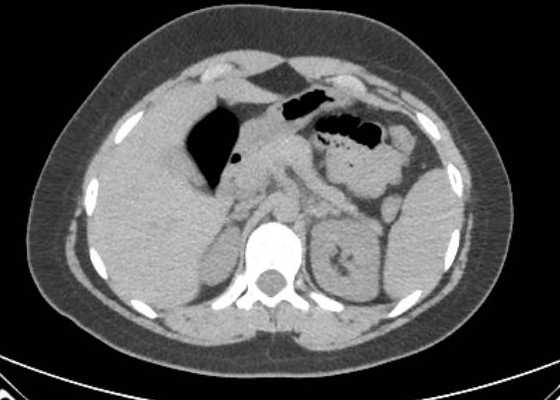 Acute unilateral nonhemorrhagic adrenal infarction (Radiopaedia 67560-76957 Axial non-contrast 36).jpg