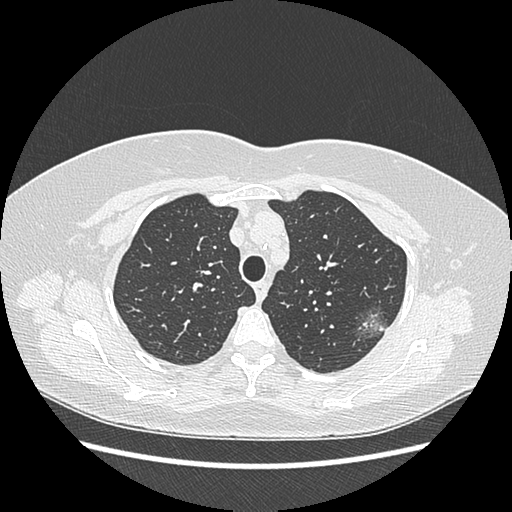 Adenocarcinoma in situ of lung (Radiopaedia 38685-40829 B 56).png