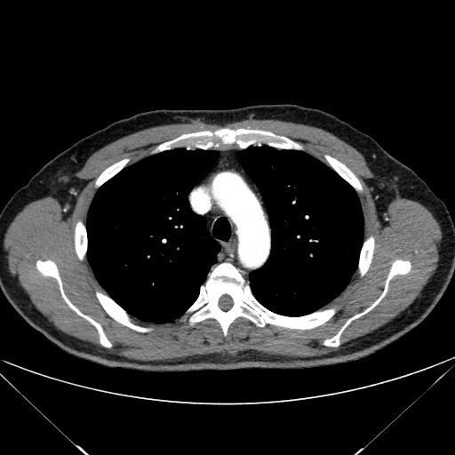 Adenocarcinoma of the lung (Radiopaedia 59871-67325 Axial C+ arterial phase 27).jpg
