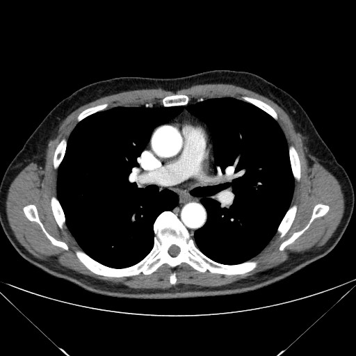 File:Adenocarcinoma of the lung (Radiopaedia 59871-67325 Axial C+ arterial phase 42).jpg