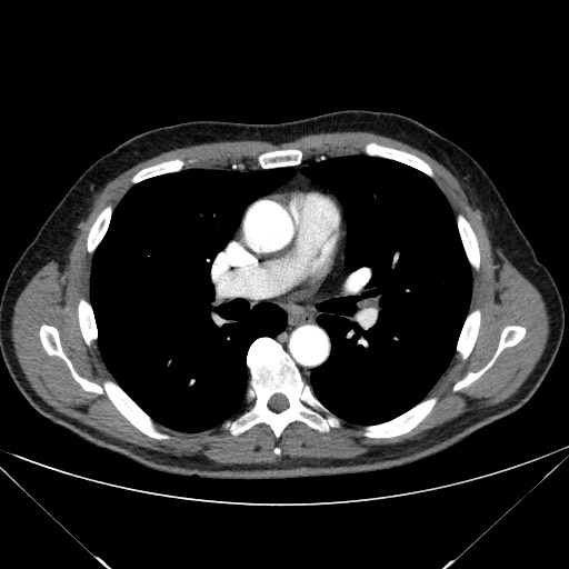 File:Adenocarcinoma of the lung (Radiopaedia 59871-67325 Axial C+ arterial phase 44).jpg