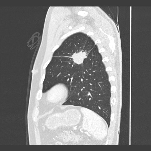 Adenocarcinoma of the lung (Radiopaedia 59871-67325 Sagittal lung window 83).jpg