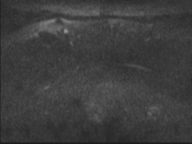 Adenocarcioma of rectum- T1 lesion (Radiopaedia 36921-38546 Axial DWI 64).png