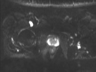 Adenocarcioma of rectum- T1 lesion (Radiopaedia 36921-38546 Axial DWI 9).png