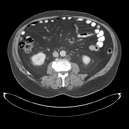 File:Adenocarcioma of rectum- T1 lesion (Radiopaedia 36921-38547 Axial C+ portal venous phase 44).png