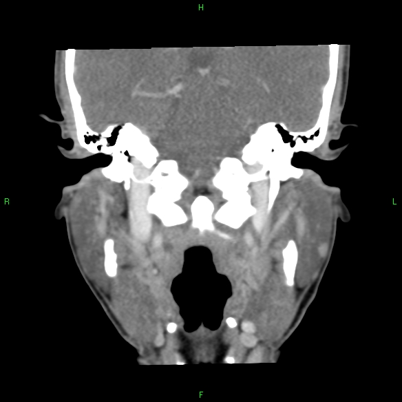 File:Adenoid cystic carcinoma of hard palate (Radiopaedia 26137-26273 Coronal liver window 24).jpg