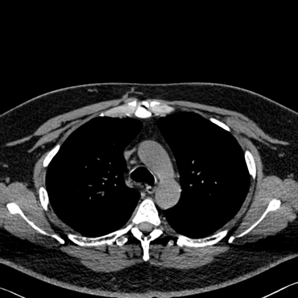 File:Adenoid cystic carcinoma of the trachea (Radiopaedia 49042-54137 Axial non-contrast 105).jpg