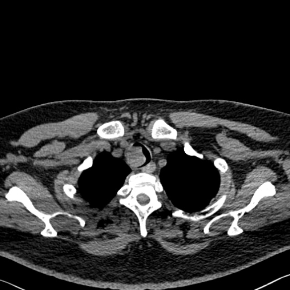 Adenoid cystic carcinoma of the trachea (Radiopaedia 49042-54137 Axial non-contrast 39).jpg