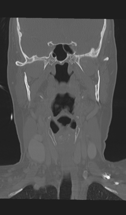 Adenoid cystic tumor of palate (Radiopaedia 46980-51518 Coronal bone window 33).png
