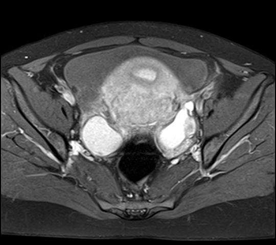 File:Adenomyosis - ovarian endometriomas (Radiopaedia 67031-76350 Axial T1 C+ fat sat 14).jpg