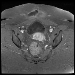 File:Adenomyosis within a didelphys uterus (Radiopaedia 70175-80215 Axial T1 C+ fat sat 27).jpg