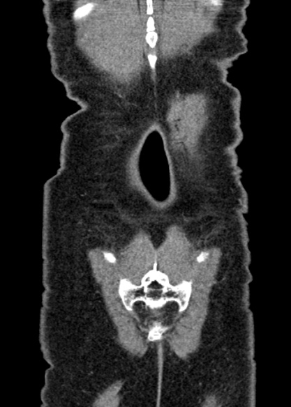 Adhesional small bowel obstruction (Radiopaedia 48397-53305 Coronal C+ portal venous phase 331).jpg