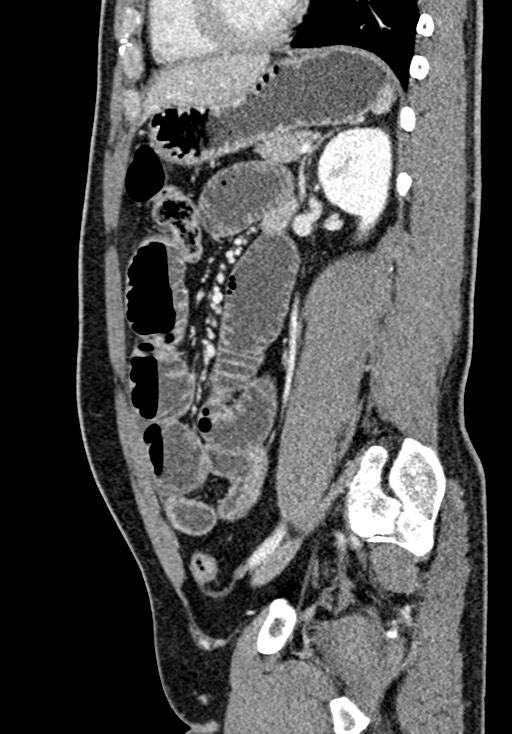 Adhesional small bowel obstruction (Radiopaedia 58900-66131 Sagittal C+ portal venous phase 160).jpg