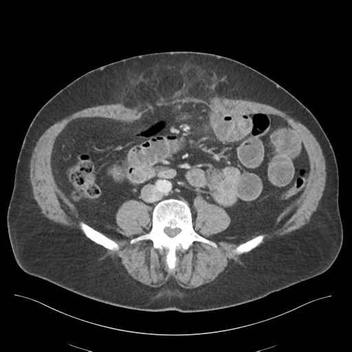 File:Adhesions within abdominal wall hernia (Radiopaedia 58283-65394 Axial C+ portal venous phase 50).png
