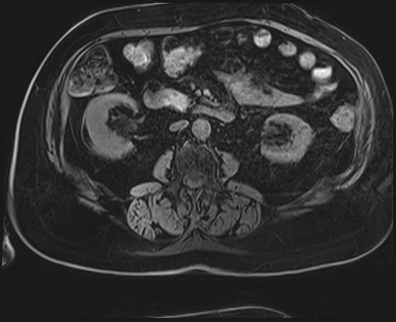 Adrenal cortical carcinoma (Radiopaedia 64017-72770 Axial T1 C+ fat sat 31).jpg