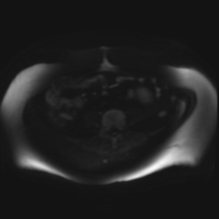 Adrenal cortical carcinoma (Radiopaedia 70906-81116 Axial DWI 55).jpg