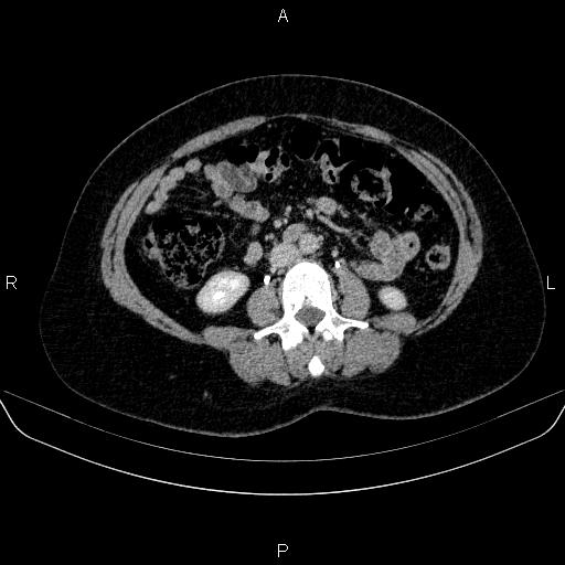Adrenal cortical carcinoma (Radiopaedia 84882-100379 Axial C+ delayed 46).jpg