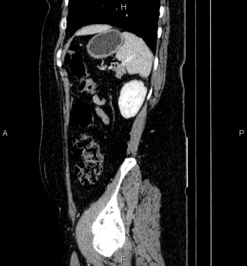 Adrenal cortical carcinoma (Radiopaedia 84882-100379 Sagittal C+ portal venous phase 71).jpg