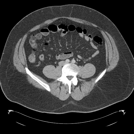 File:Adrenal cyst (Radiopaedia 45625-49776 Axial C+ portal venous phase 62).png