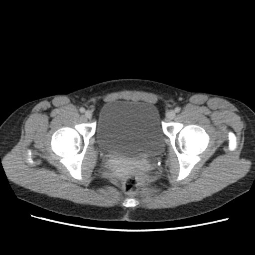 File:Adrenal cyst (Radiopaedia 64869-73813 Axial C+ portal venous phase 76).jpg