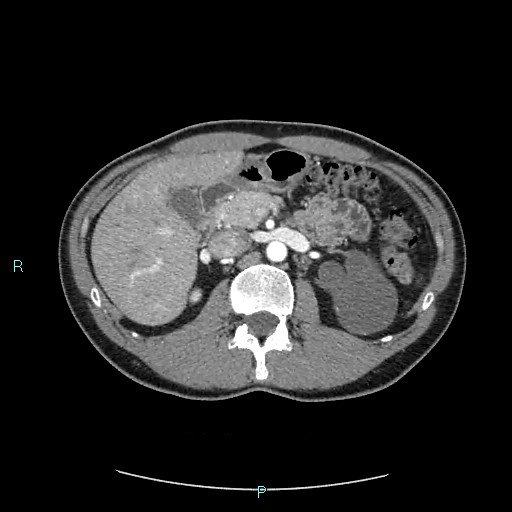 File:Adrenal cystic lymphangioma (Radiopaedia 83161-97534 Axial C+ arterial phase 34).jpg