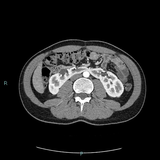 File:Adrenal cystic lymphangioma (Radiopaedia 83161-97534 Axial C+ arterial phase 48).jpg