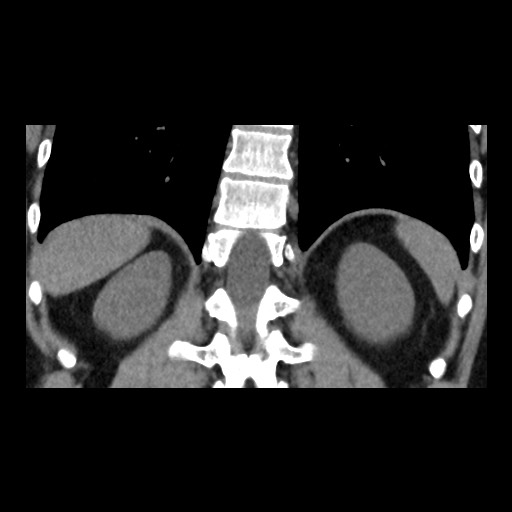 Adrenal gland trauma (Radiopaedia 81351-95079 Coronal non-contrast 68).jpg