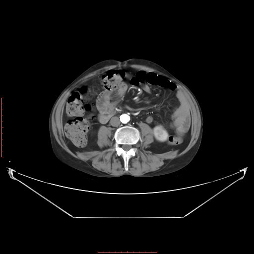 Adrenal hemangioma (Radiopaedia 68923-78668 Axial C+ arterial phase 43).jpg