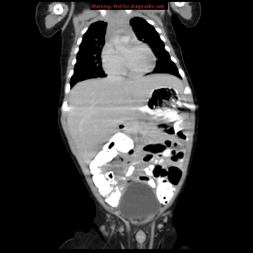 File:Adrenal hemorrhage (Radiopaedia 9390-10077 Coronal C+ portal venous phase 1).jpg