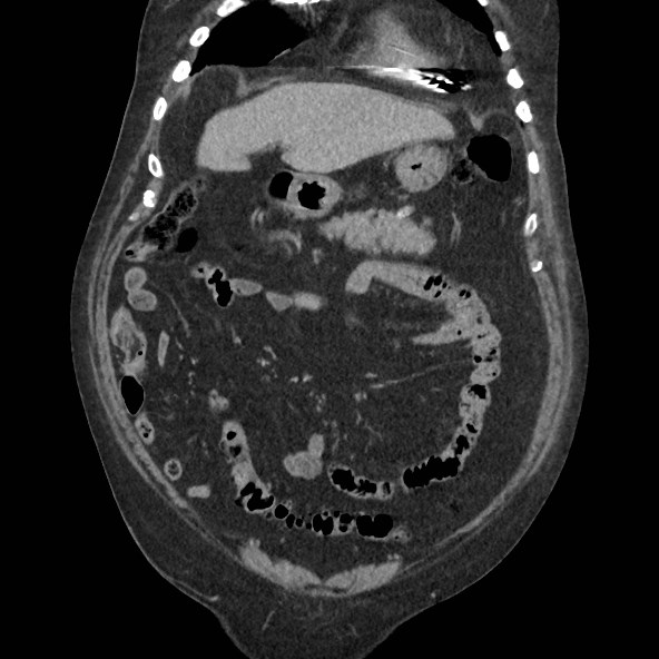 Adrenal lymphoma (Radiopaedia 84145-99415 Coronal C+ portal venous phase 21).jpg