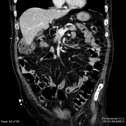 Adrenal metastasis (Radiopaedia 78425-91079 Sagittal C+ portal venous phase 20).jpg