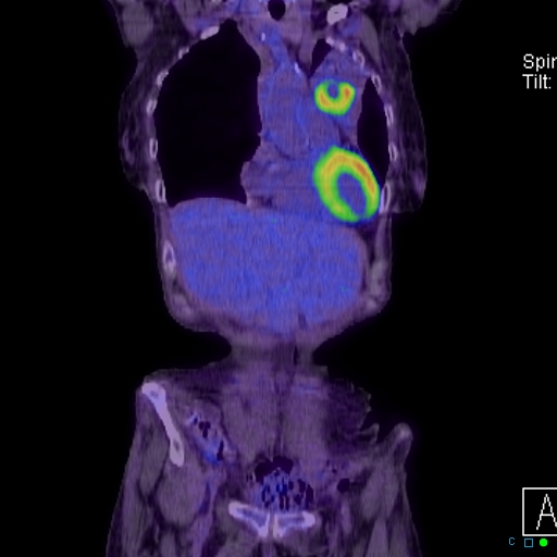 File:Adrenal metastasis from small cell lung cancer (Radiopaedia 19133-19109 Coronal 4).jpg