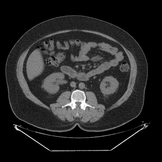 Adrenal myelolipoma (Radiopaedia 26278-26407 Axial non-contrast 33).jpg