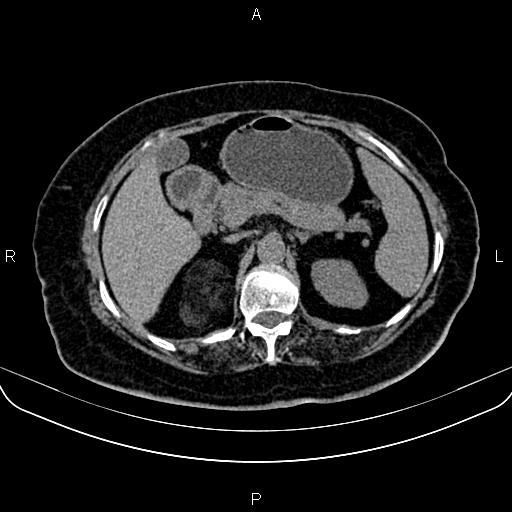 Adrenal myelolipoma (Radiopaedia 82742-96986 Axial non-contrast 47).jpg