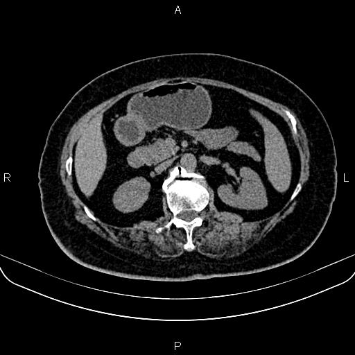 Adrenal myelolipoma (Radiopaedia 82742-96986 Axial non-contrast 61).jpg