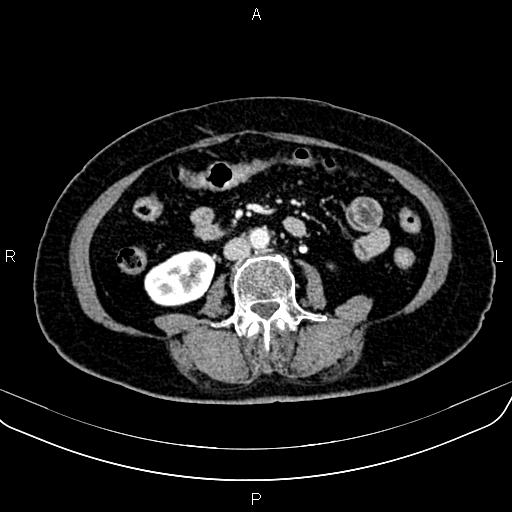 Adrenal myelolipoma (Radiopaedia 82742-96986 Axial renal cortical phase 95).jpg