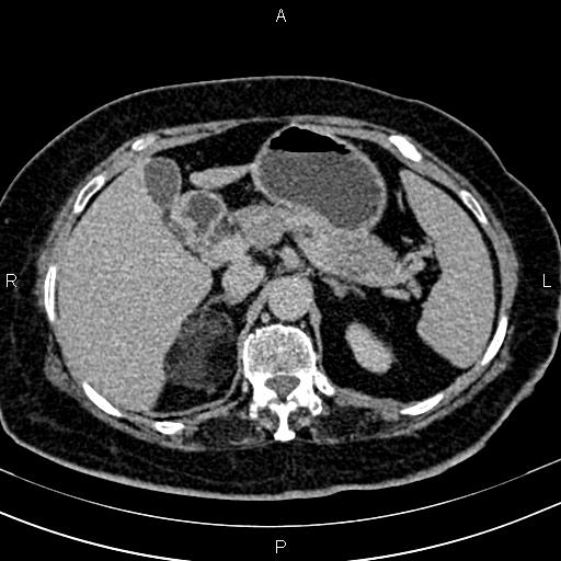 Adrenal myelolipoma (Radiopaedia 82742-96986 Axial renal excretory phase 37).jpg