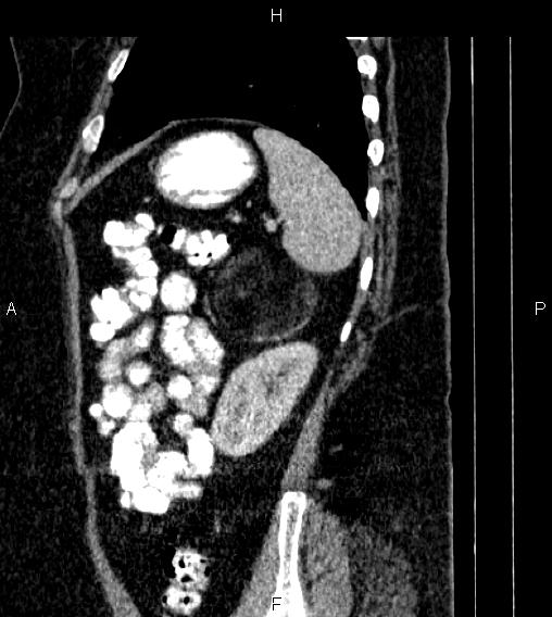 Adrenal myelolipoma (Radiopaedia 84319-99617 Sagittal renal cortical phase 77).jpg