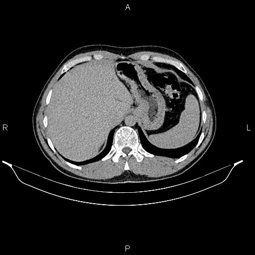 Adrenal myelolipoma (Radiopaedia 87794-104246 Axial renal excretory phase 18).jpg