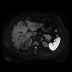 File:Adrenal myelolipoma - MRI (Radiopaedia 83249-97646 Axial DWI 9).jpg